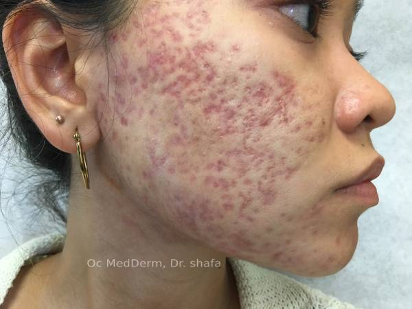 Fractional CO2 Laser Treatment საქართველო