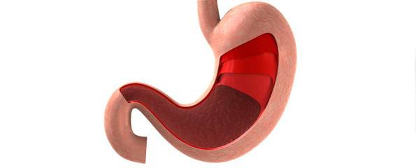 Gastric Banding საქართველო