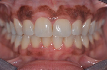 Gum Depigmentation საქართველო