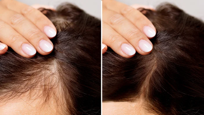 Hair Loss Treatment საქართველო