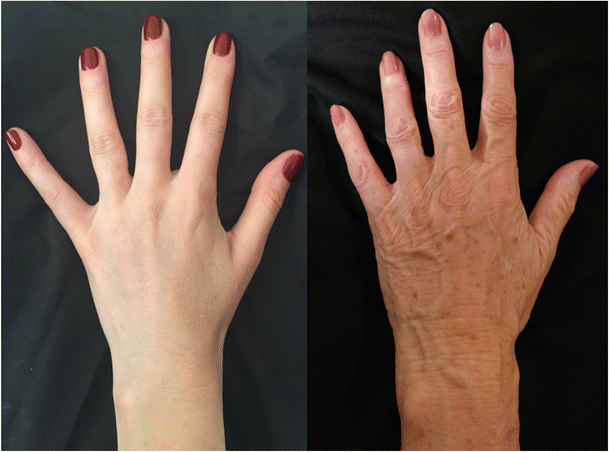 Hand Rejuvenation With Fat Transfer Georgia