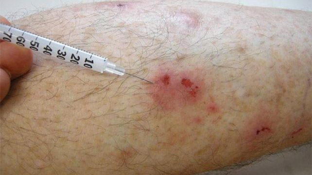 Hypertrophic Scar Removal საქართველო