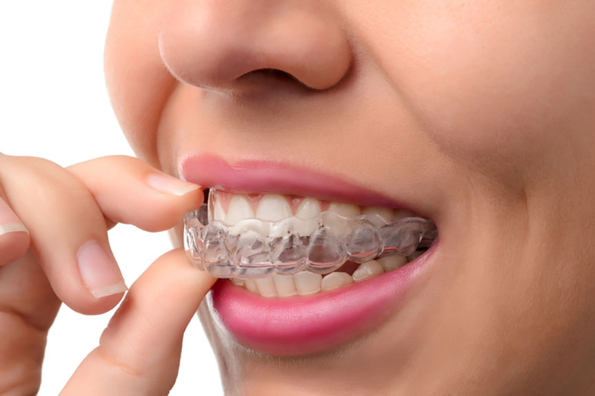 Invisalign Braces Treatment საქართველო