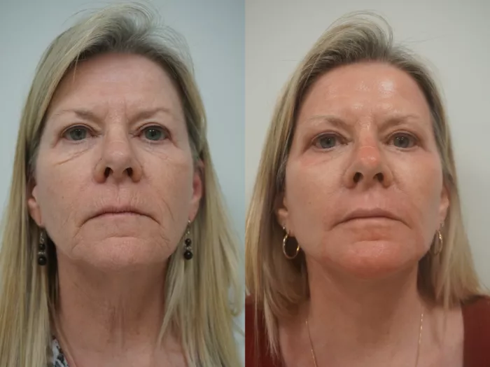 J Plasma Skin Resurfacing საქართველო