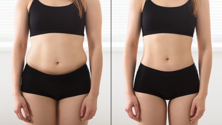 Laser Liposuction საქართველო