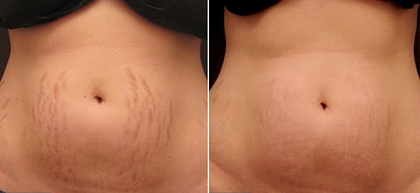 Stretch Marks Removal საქართველო