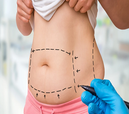 Liposuction surgery საქართველო