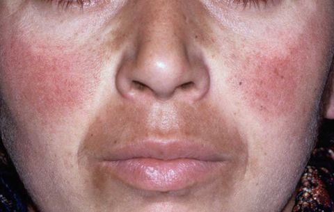 Melasma Treatment საქართველო
