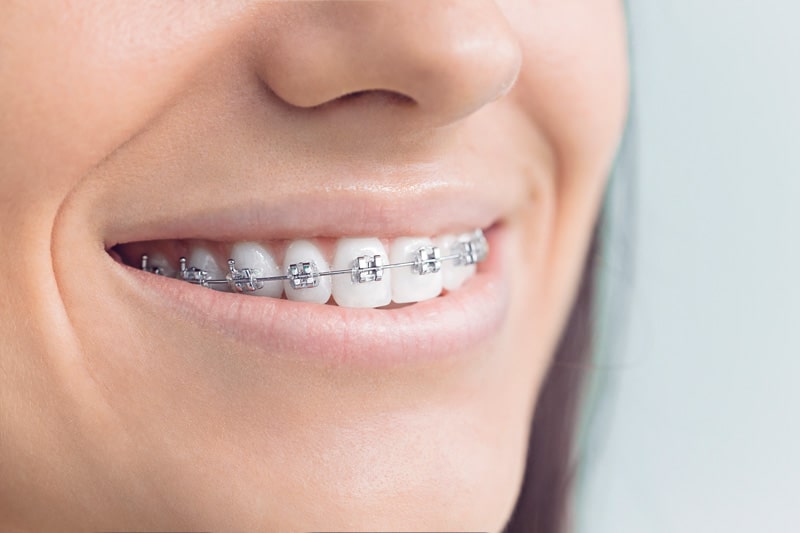 Metal Braces საქართველო
