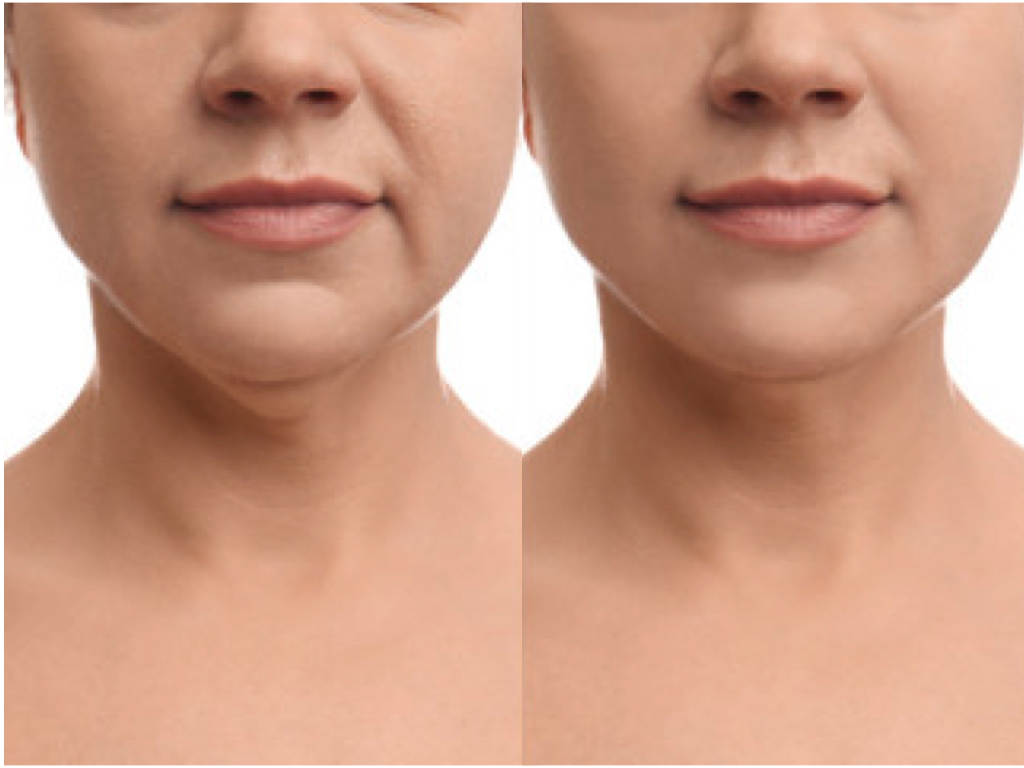 Nefertiti Lift Abu Treatment საქართველო