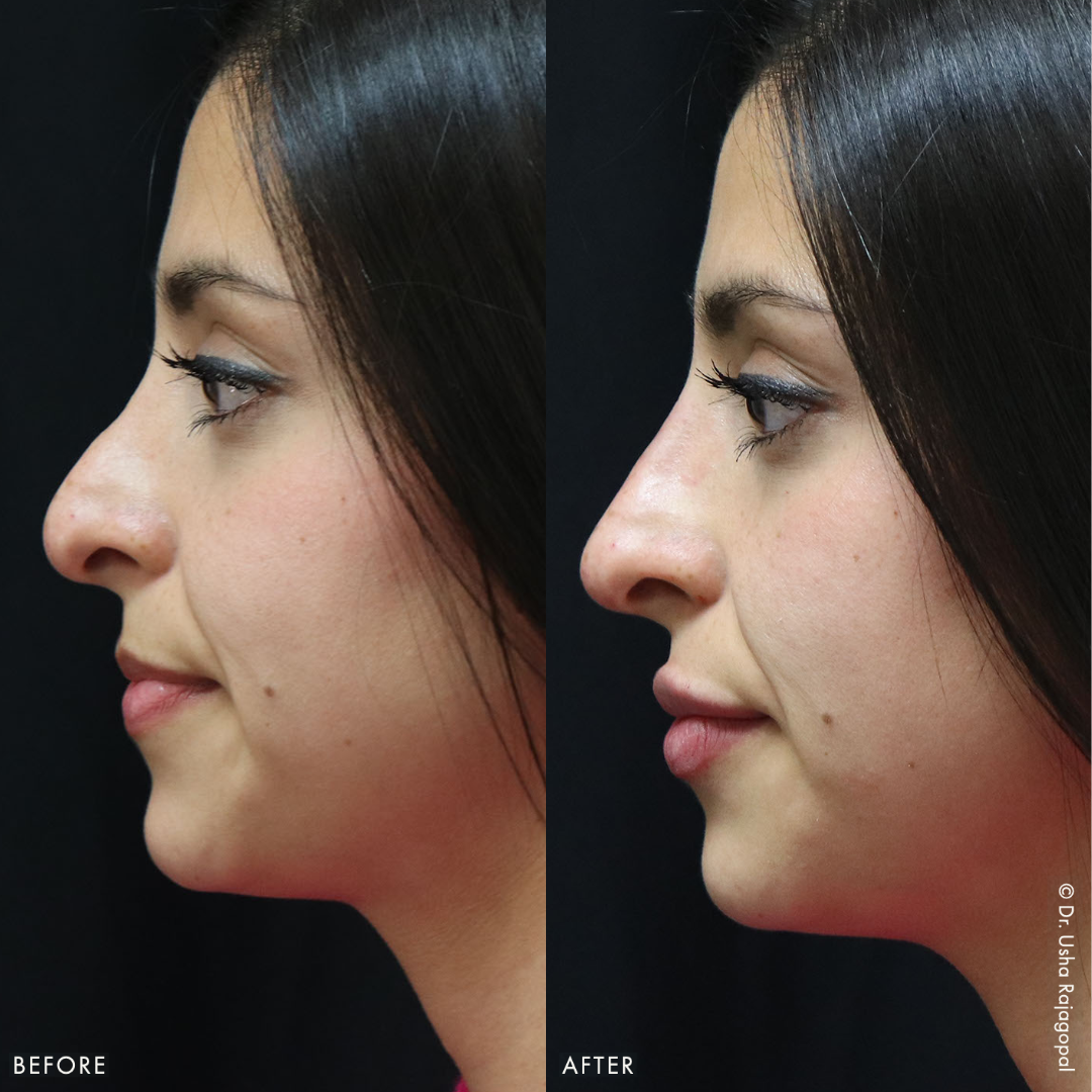 Non Surgical Nose Job საქართველო