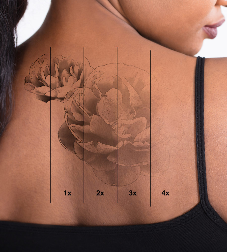 Picosure Tattoo Removal საქართველო