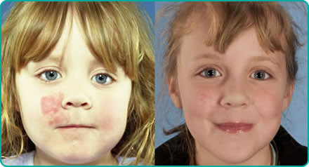 Port Wine Stains Removal საქართველო