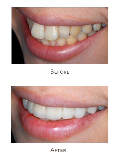 Protruding Teeth Treatment საქართველო