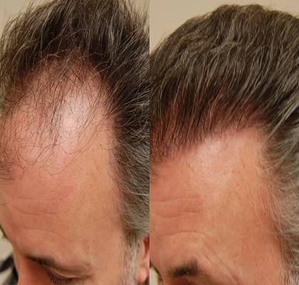 Robotic Hair Transplant საქართველო