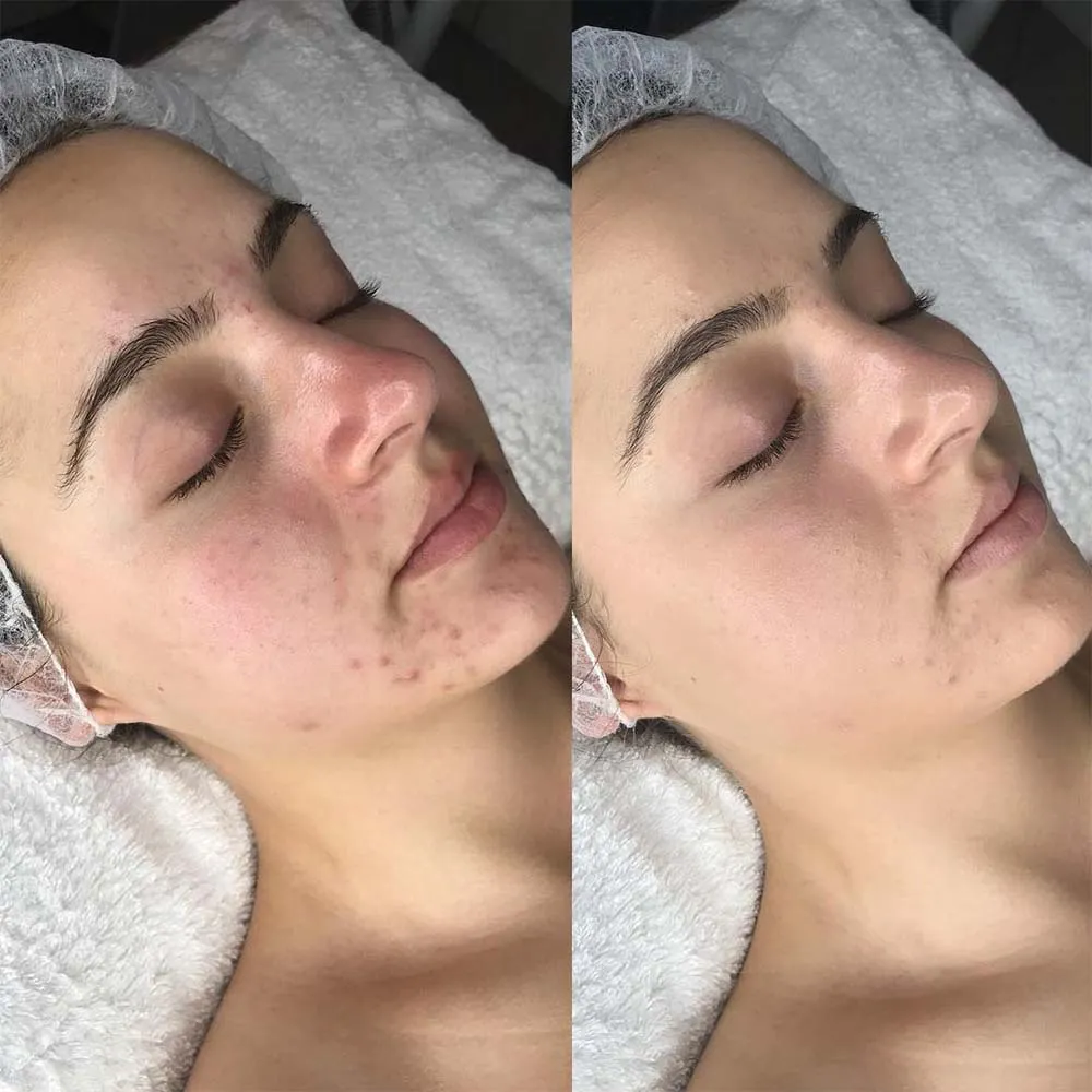 Salicylic Acid Peeling საქართველო