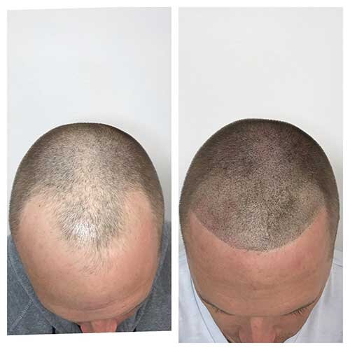 Scalp Micropigmentation საქართველო