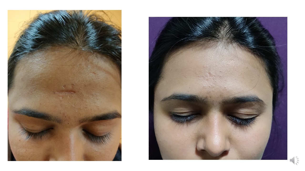 Facial Scar Revision საქართველო