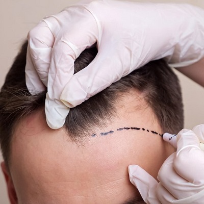 Scarless Hair Transplant საქართველო