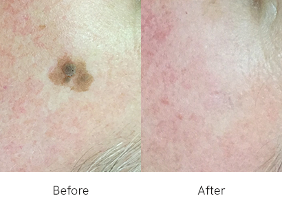 Seborrheic Keratosis Treatment საქართველო