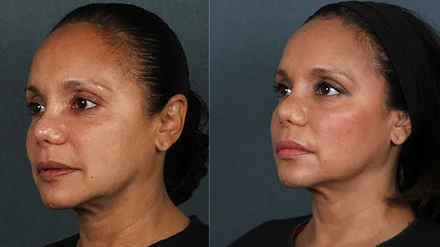 Silhouette Facelift საქართველო