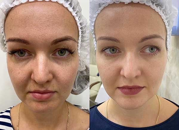 Spectra Laser Carbon Peel საქართველო