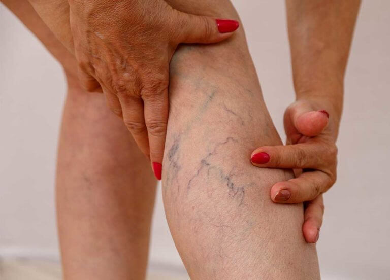 Spider Veins Treatment საქართველო