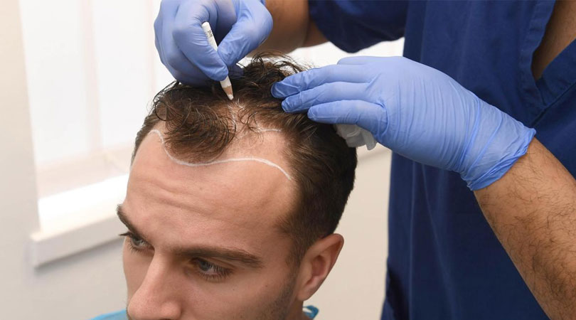 Stem Cell Hair Transplant საქართველო