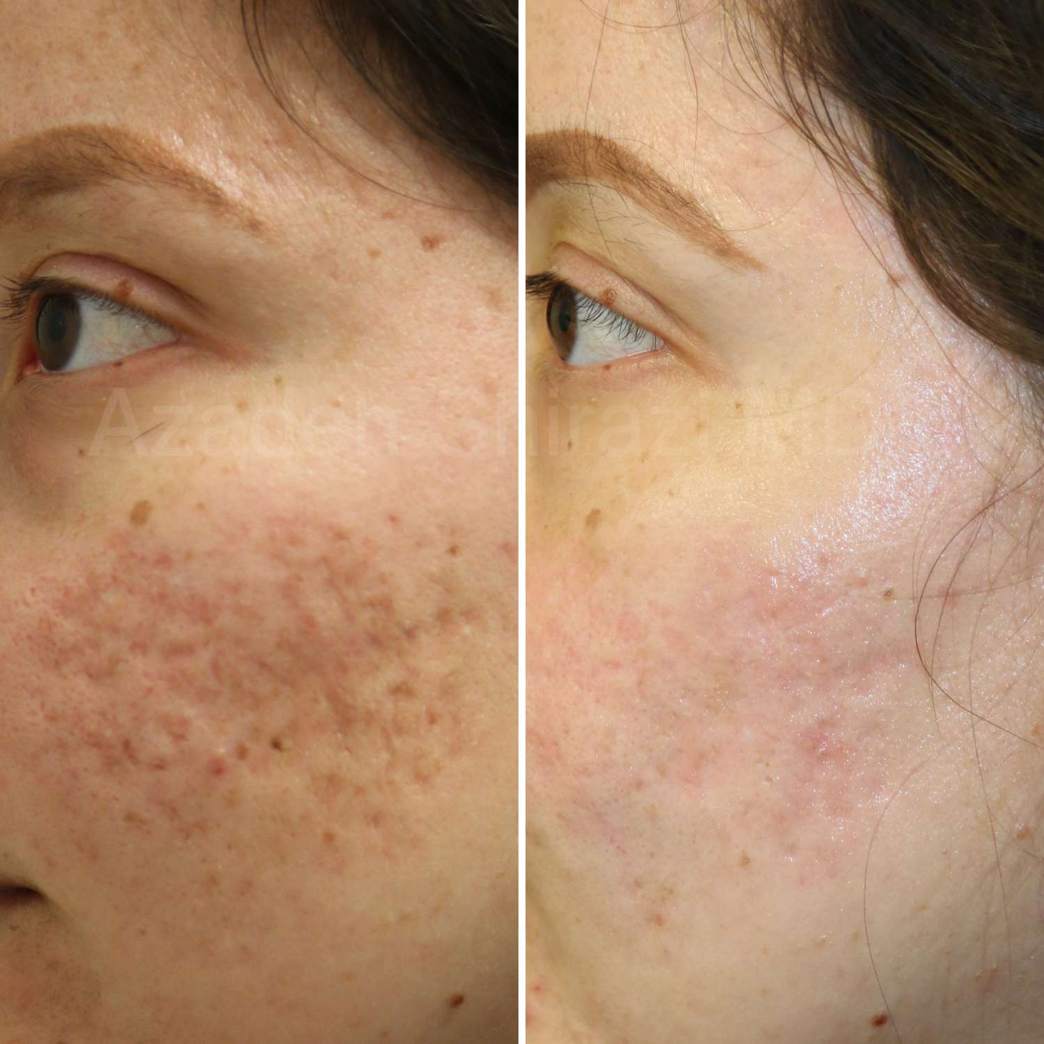 Subcision Treatment for Acne Scar საქართველო