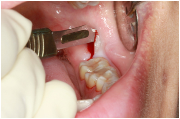 Surgical Tooth Removal საქართველო