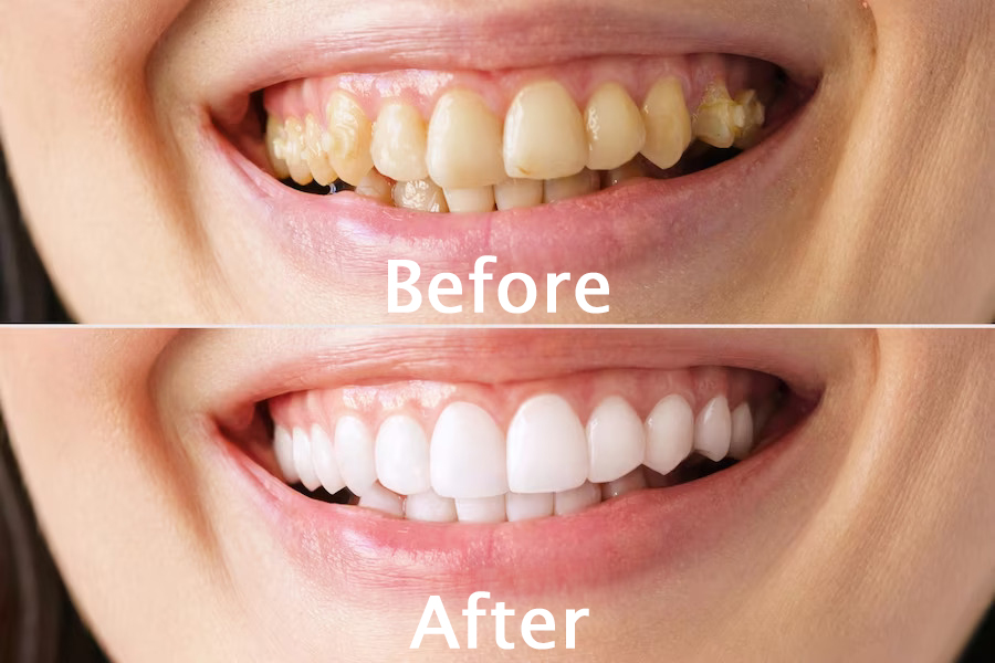 Teeth Cleaning საქართველო