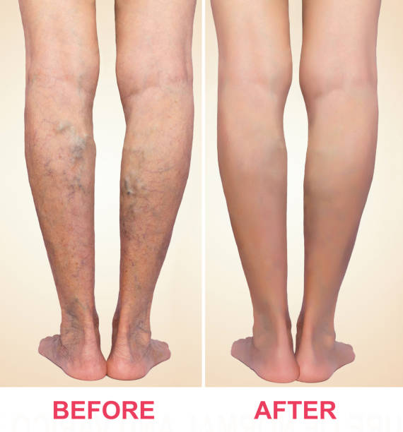 Varicose Veins Treatment საქართველო