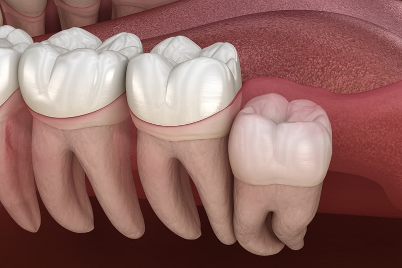 Wisdom Tooth Extraction საქართველო